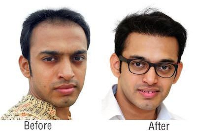 Overcome Baldness With These Richfeel Hair Treatment Reviews