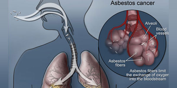 Asbestos Health Risks